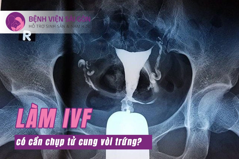 Làm IVF có cần chụp tử cung vòi trứng không