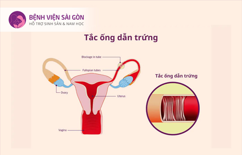Hai bên ống dẫn trứng thì bắt buộc phải chọn IVF để tìm con