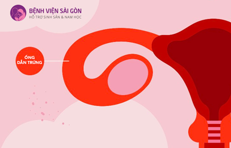 Nếu chỉ có 1 bên 1 vòi trứng bị tắc thì có thể lựa chọn phương pháp IUI
