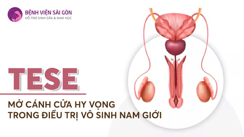 TESE - Mở cánh cửa hy vọng trong điều trị vô sinh nam giới
