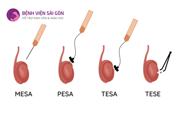 TESE là kỹ thuật lấy mẫu mô tinh hoàn để tìm kiếm tinh trùng trực tiếp