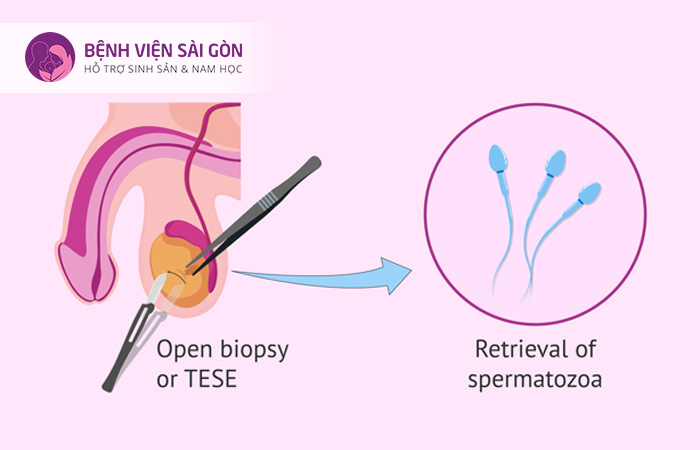 Mẫu mô tinh hoàn sẽ được gửi đến phòng Labo để kiểm tra dưới kính hiển vi xem có tinh trùng hay không