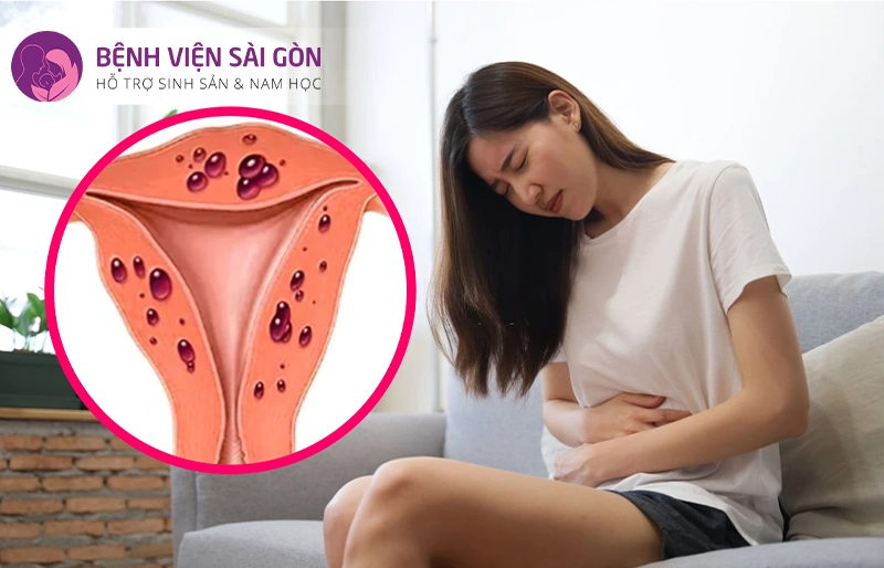 Bệnh lạc nội mạc tử cung Bệnh lạc nội mạc tử cung