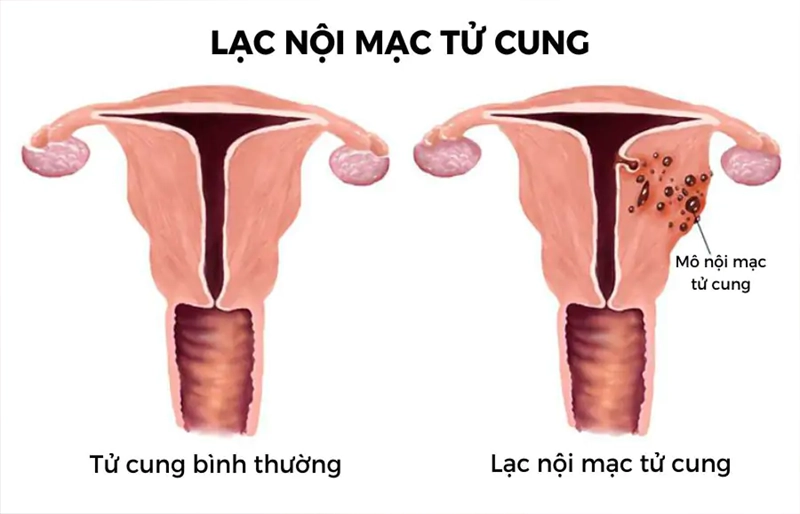 Nguyên nhân và quá trình điều trị vô sinh