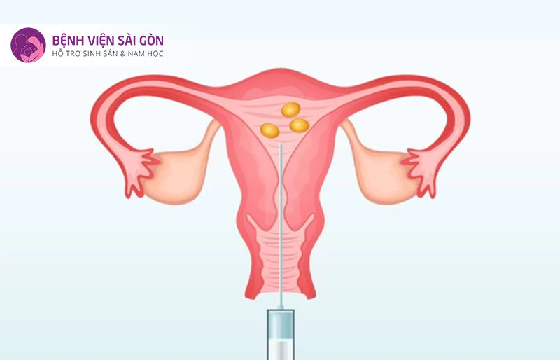 Gom bao nhiêu trứng là đủ