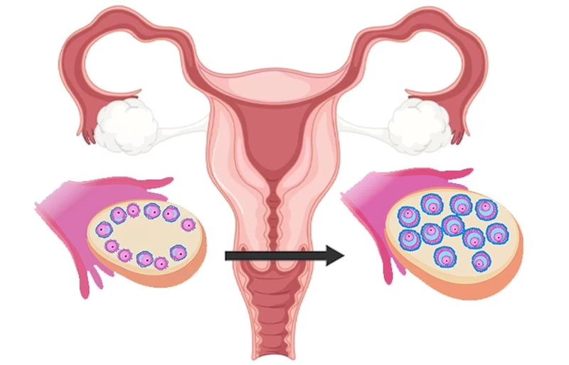 Tác dụng phụ sau khi tiêm IVF