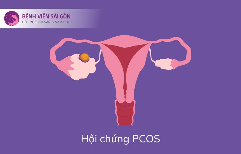 Người mắc hội chứng buồng trứng đa nang (PCOS) Người mắc hội chứng buồng trứng đa nang (PCOS)