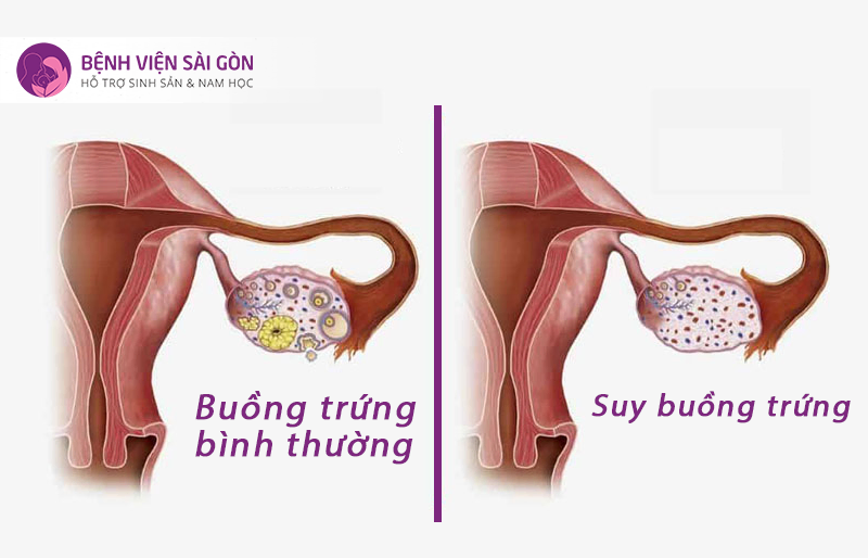 Người bệnh suy buồng trứng sớm