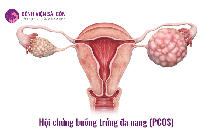 Hội chứng buồng trứng đa nang