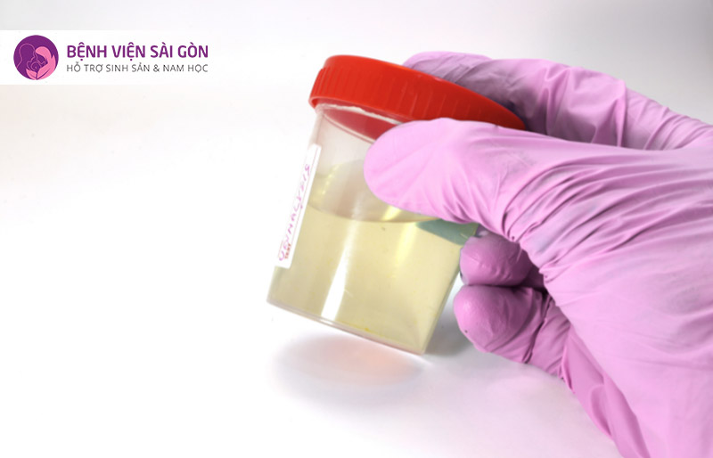 Xét nghiệm nước tiểu sau xuất tinh Xét nghiệm nước tiểu sau xuất tinh