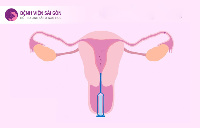 Phương pháp thụ tinh nhân tạo IUI Phương pháp thụ tinh nhân tạo IUI