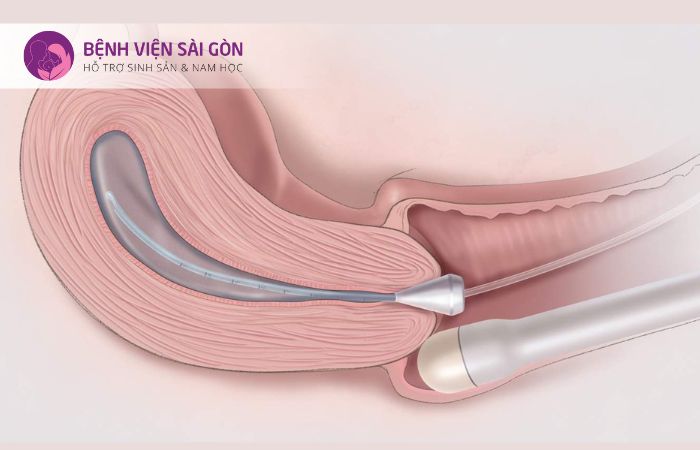 Siêu âm đầu dò âm đạo Siêu âm đầu dò âm đạo