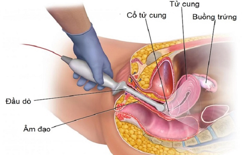 siêu âm đầu dò âm đạo