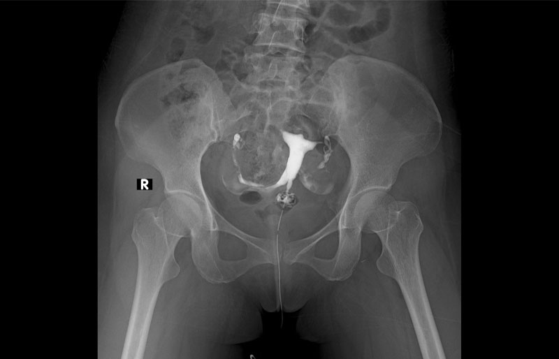 Xét nghiệm nội tiết tố bao gồm chụp HSG Xét nghiệm nội tiết tố bao gồm chụp HSG