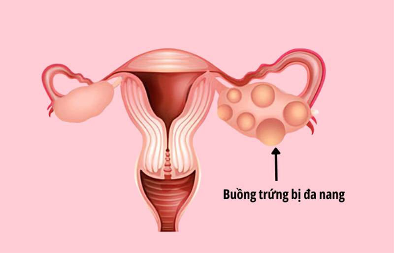 Hội chứng buồng trứng đa nang (PCOS)