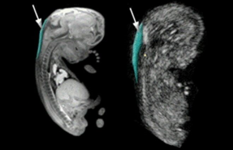 Khám thai 12 tuần mẹ bầu cần thực hiện siêu âm đo đồ mờ da gáy