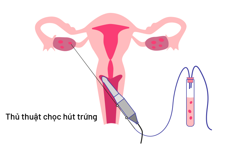 Chọc hút trứng