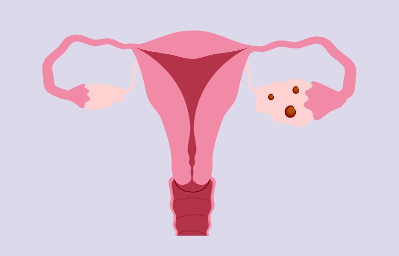 Hội chứng quá kích thích buồng trứng Hội chứng quá kích thích buồng trứng