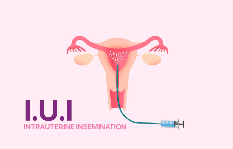 Chi phí thụ tinh nhân tạo IUI