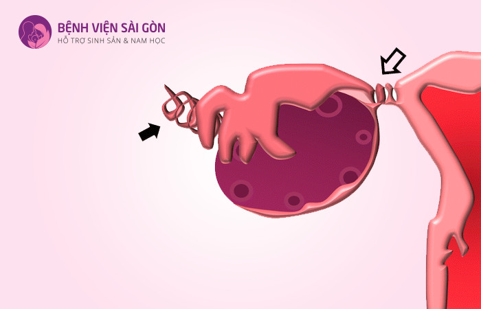 Việc phát hiện sớm tình trạng xoắn buồng trứng giúp bảo vệ được khả năng sinh sản của nữ giới