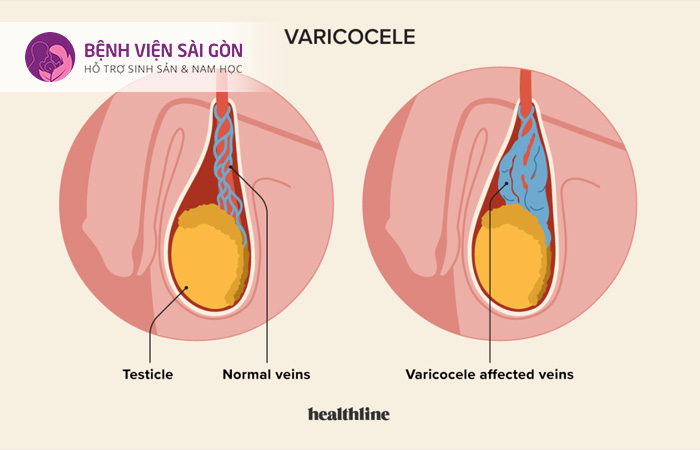 Xét nghiệm di truyền tiền làm tổ giúp phát hiện các bất thường di truyền trong tế bào phôi