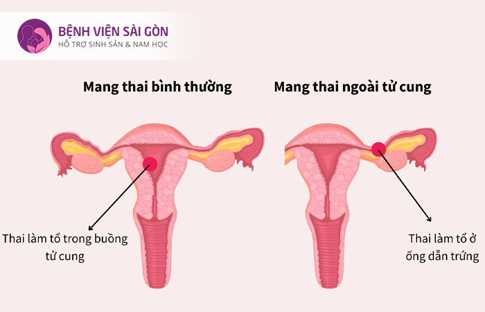 Thị lực của người mẹ thay đổi dẫn đến chứng mờ mắt khi mang thai