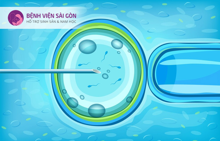 IVF mini giảm thiểu tình trạng quá kích buồng trứng
