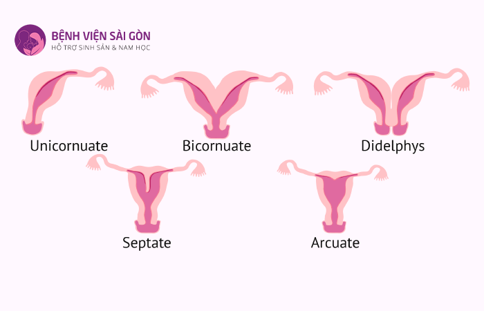 Nguyên nhân khiến tử cung dị dạng là do gen di truyền