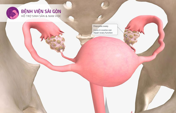 Đa nang buồng trứng là nguyên nhân dẫn đến kinh nguyệt không đều