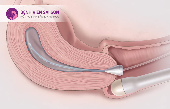 Âm đạo, cổ tử cung bị viêm là biến chứng của tình trạng nhiễm trùng hậu sản