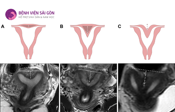 Tử cung có vạch ngăn là loại tử cung dị dạng chiếm 40%