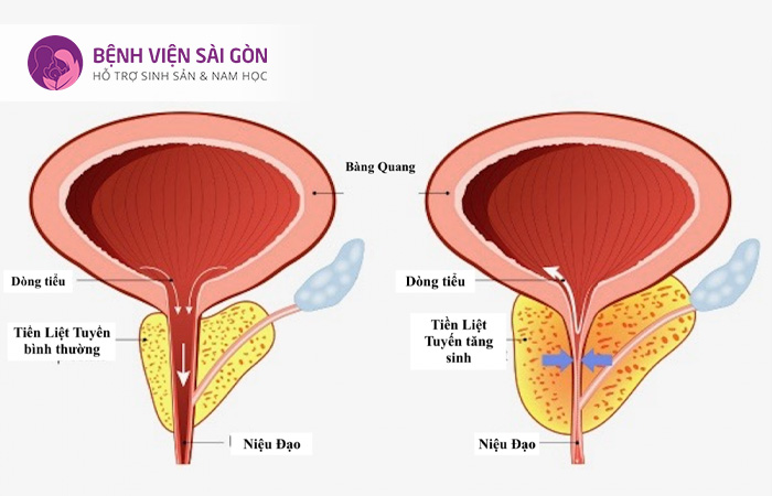Tăng sản tuyến tiền liệt là một bệnh phổ biến của hệ bài tiết