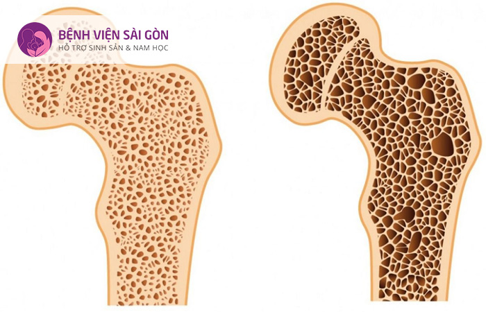 Lạc nội mạc tử cung sẽ khiến chảy máu bất thường trong kỳ kinh