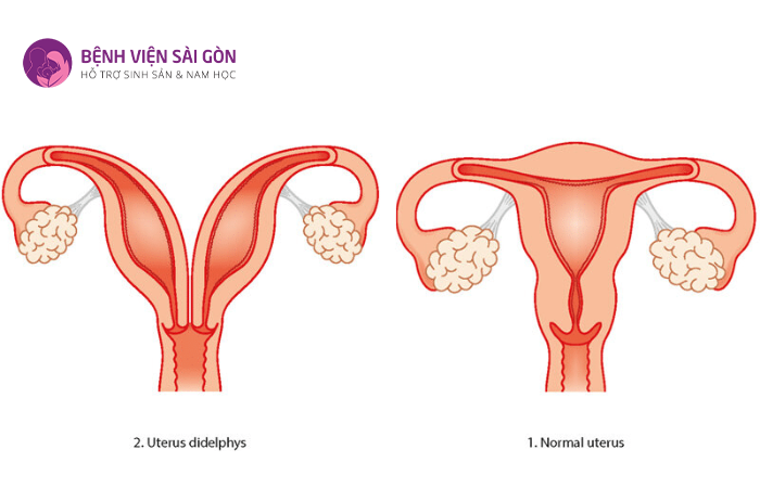 Những người không có tử cung là những đối tượng không thể mang thai
