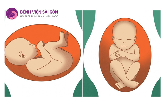 Ngôi thai bất thường là nguyên nhân gây ra tình trạng sa dây rốn