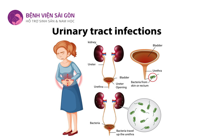 Bệnh lý xảy ra do sự xâm nhập vào hệ bài tiết và gây bệnh của vi khuẩn