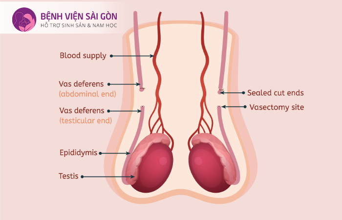 Sau khi thắt ống dẫn tinh nếu nam giới muốn có con thì lựa chọn IVF