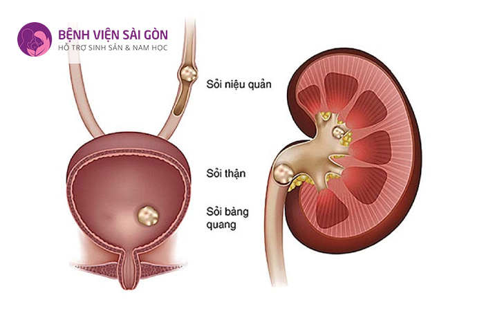 Là tình trạng xuất hiện sỏi trong hệ bài tiết