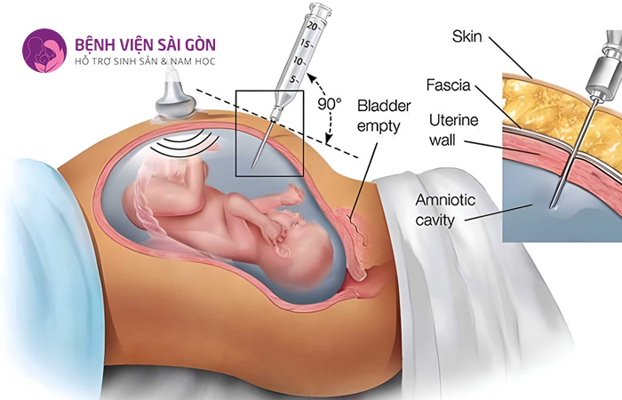 Chọc ối là phương pháp chẩn đoán các bất thường về nhiễm sắc thể