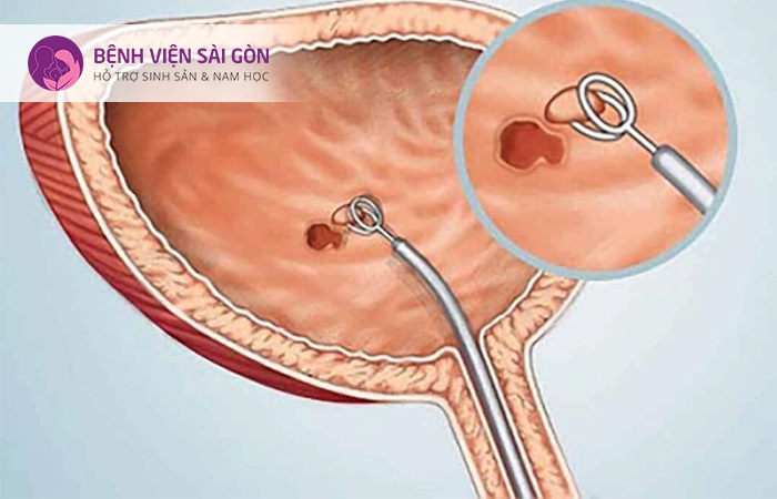 Bệnh lý này khiến cho bàng quan của hệ bài tiết mất đi tính đàn hồi