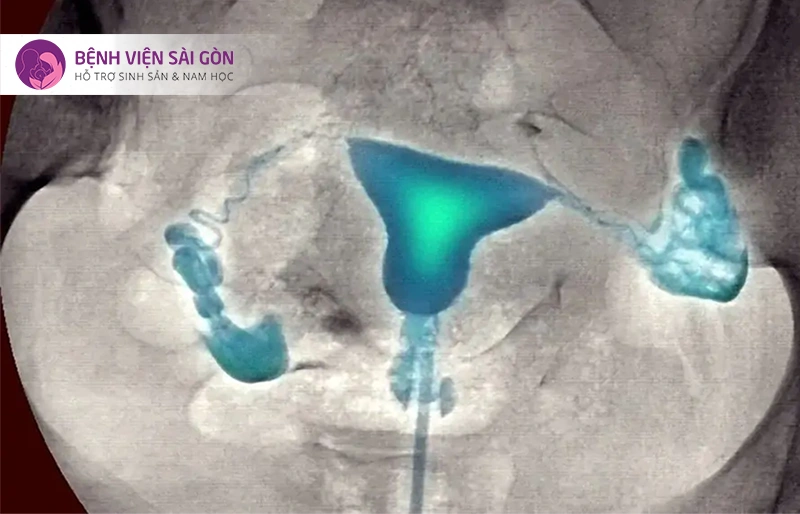 Chụp tử cung - vòi trứng (HSG)
