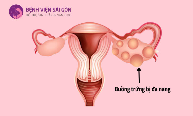 Nữ giới mắc PCOS cũng là nguyên nhân khiến nồng độ Prolactin trong máu cao