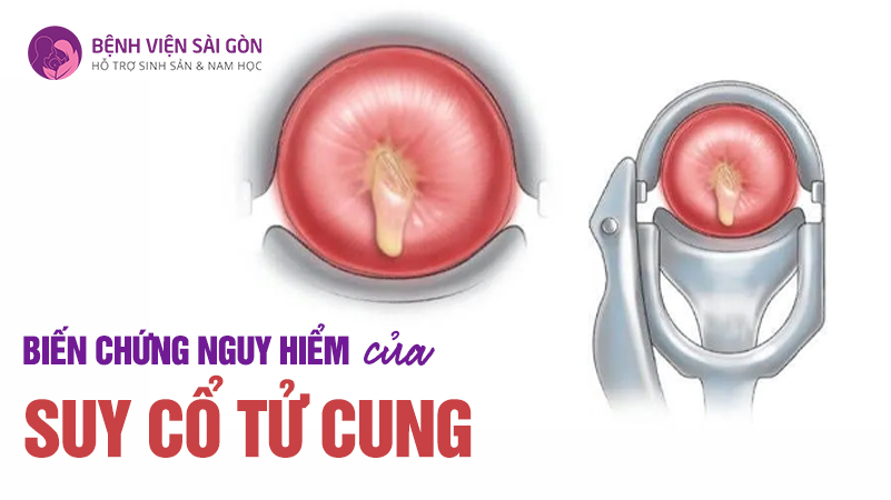 Suy cổ tử cung: nguy cơ thầm lặng đối với thai kỳ mẹ bầu không nên bỏ qua