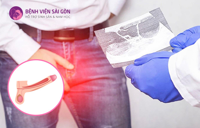 Ung thư dương vật xuất phát từ những tế bào phát triển bất thường