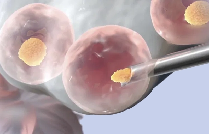 Chọc hút trứng và lấy tinh trùng