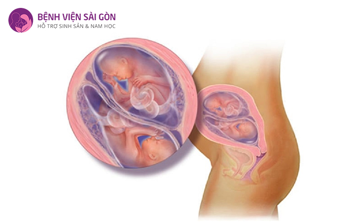 Nồng độ beta hCG càng cao tỷ lệ mang đa thai càng lớn