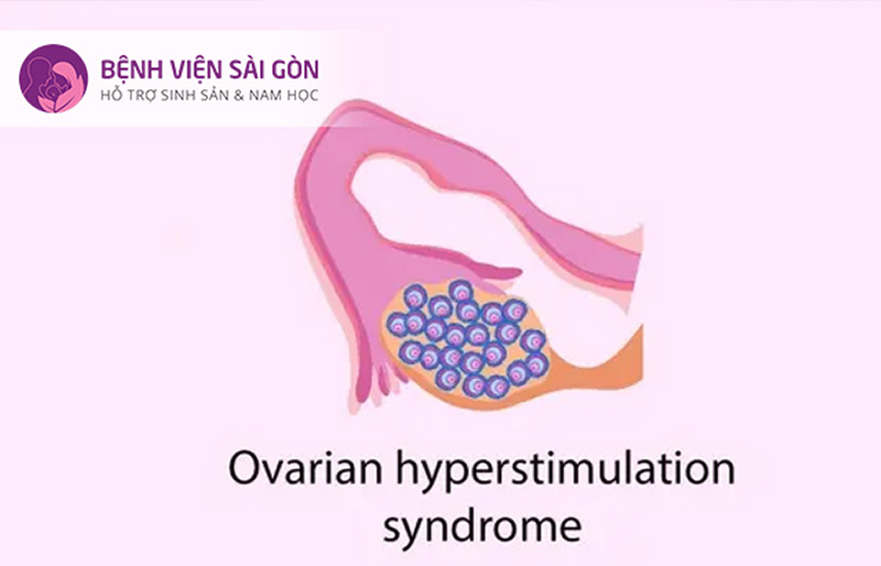 hội chứng quá kích buồng trứng (OHSS)