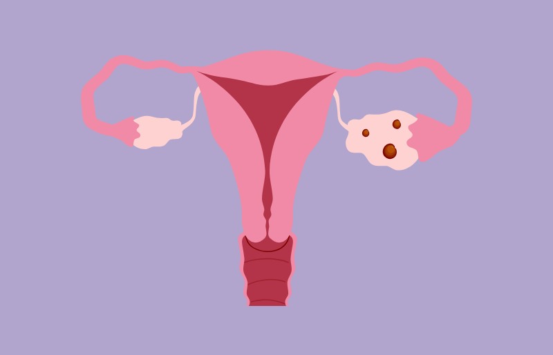 Hội chứng quá kích thích buồng trứng