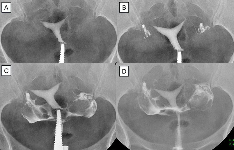Kỹ thuật chụp tử cung vòi trứng