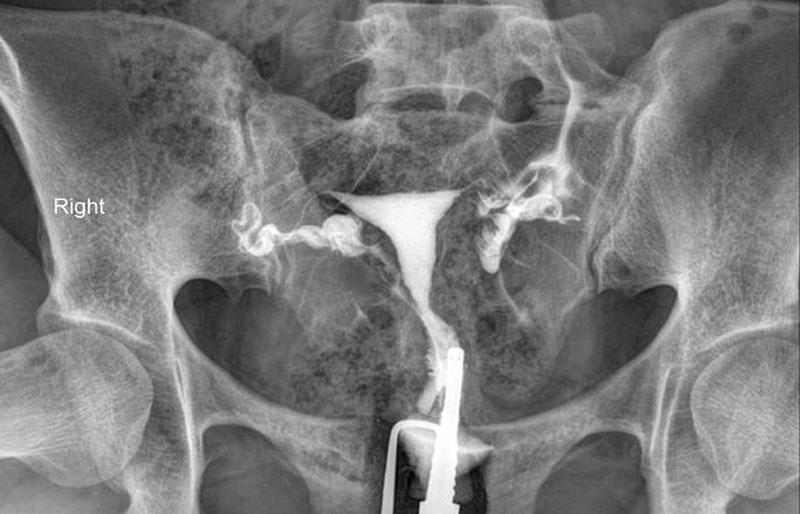 Làm IVf cần chụp cổ tử cung vòi trứng không